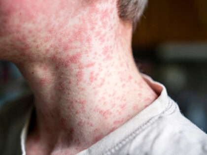 Measles viral disease, human skin covered with measles rash, vaccination concept - stock p