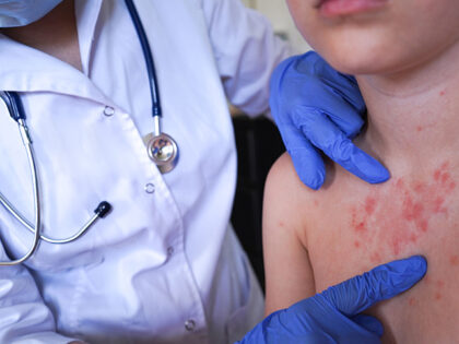 measles doctor