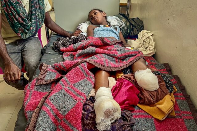 Iyerusalem, 10, needed both legs amputated after heavy shelling in Qarsole, Tigray, that a