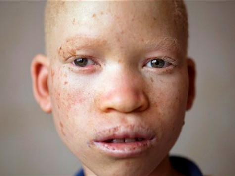 Tanzania's Albinos Hope Govt Will Offer More Help