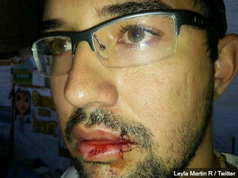 Venezuelan Students Sew Their Lips Shut to Protest Mass Government Arrests
