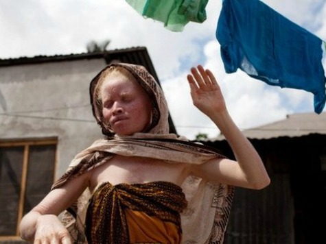 Tanzania’s Albinos ‘Killed like Animals’ for Body Parts Used in Potions