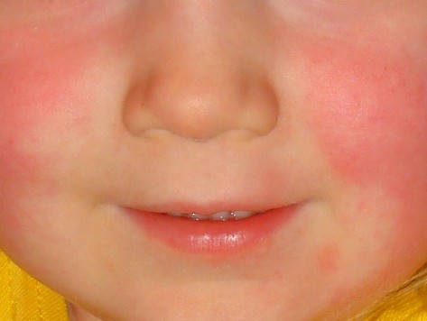 Sharp Rise in Scarlet Fever Cases in England