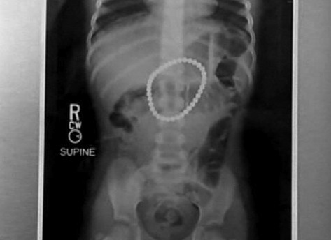 3-Year-Old Swallows 37 Magnets