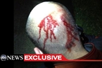 ABC News: Medical Records Support George Zimmerman's Account Of Broken Nose, Head Injuries