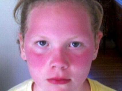 Sunscreen Ban in Schools Angers Parents