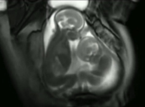 Ultrasound: Twins' Sibling Rivalry Starts Early in Mother's Womb