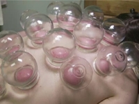 'Cupping' Treatment Becomes Hollywood Craze