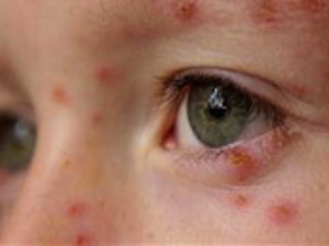 Eight Illegals Diagnosed with Chicken Pox in McAllen, TX