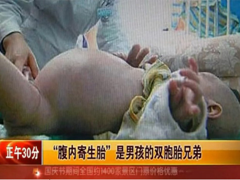 2-Year-Old Boy Has Surgery to Remove Twin Brother From His Stomach