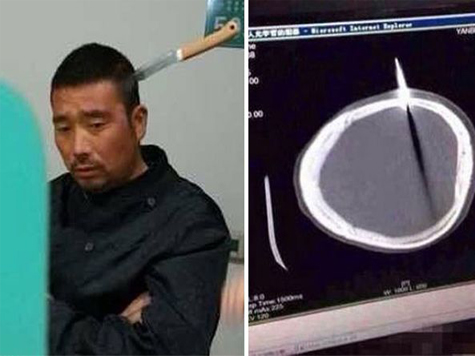 Man Walks Into Hospital With 10 Inch Knife Buried in Skull
