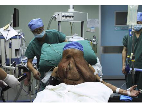 ‘China’s Elephant Man’ Has Surgery to Remove 3 Pounds Of Tumor From Face